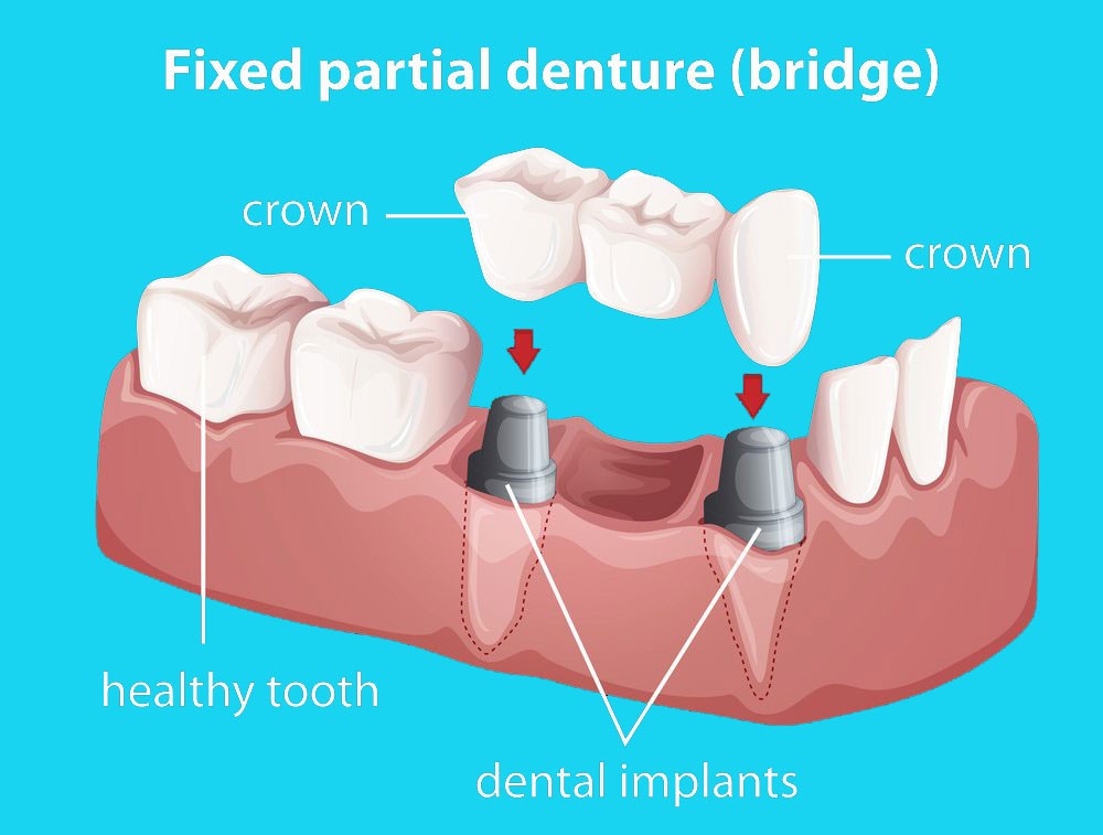 Info Graphic Of A Fixed Partial Denture