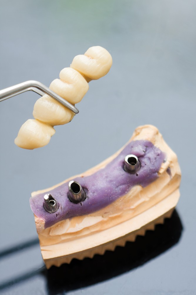 Dental implant head and bridge