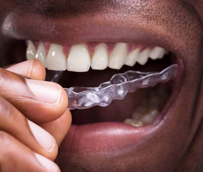 man-putting-in-night-guard-for-teeth