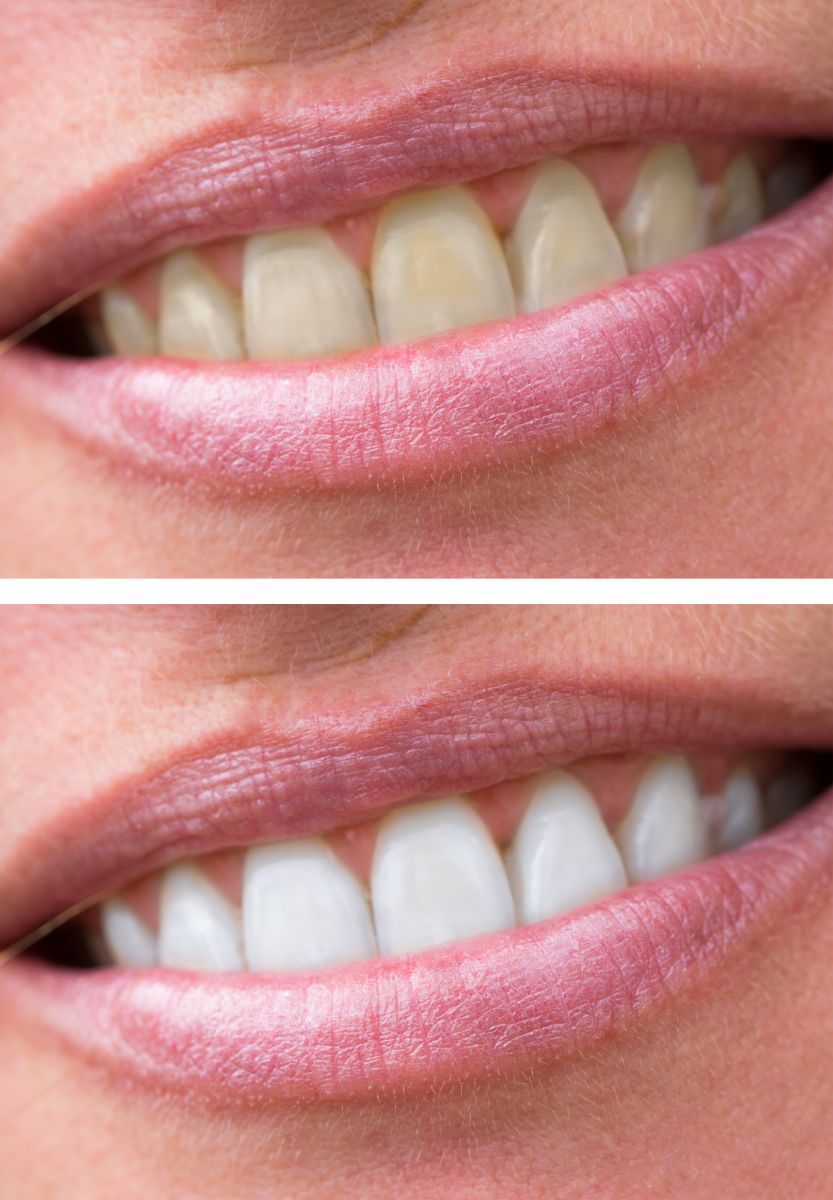 before and after teeth whitening in vorhees nj