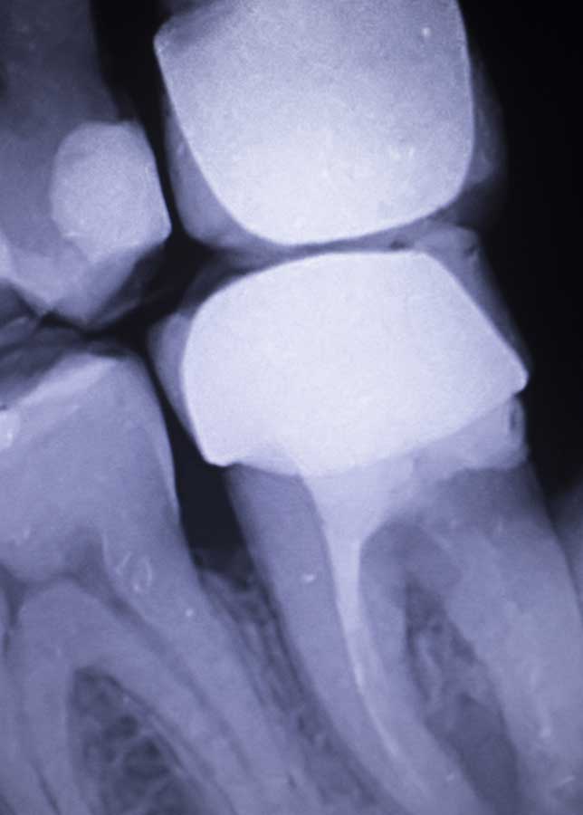 tooth-filling-dental-xray