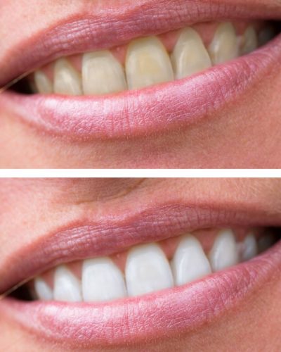 teeth whitening in vorhees nj