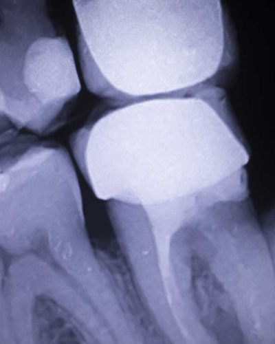 tooth-filling-dental-xray